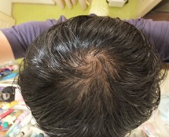 AGA治療開始1か月後の頭頂部ハゲ