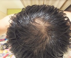 AGA治療開始前の頭頂部:つむじハゲ