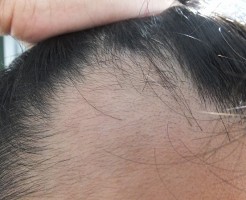 AGA治療開始1か月半後の前髪生え際:効果が出てきた!