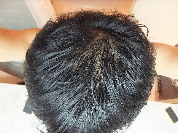 AGA治療2か月後の頭頂部：つむじハゲ