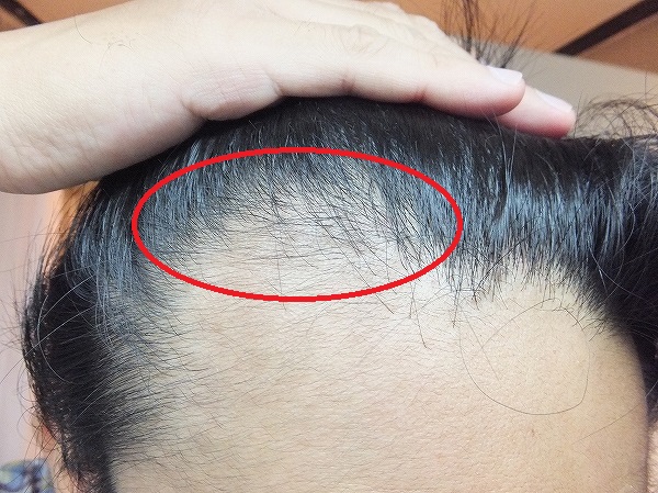 AGA治療開始2か月:発毛が感じられるM字ハゲ部分