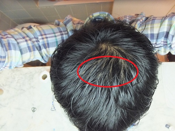 AGA治療2か月半後の頭頂部：つむじハゲ