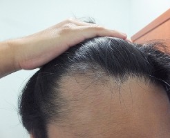 AGA治療開始3ヵ月後のM字ハゲ:前髪生え際
