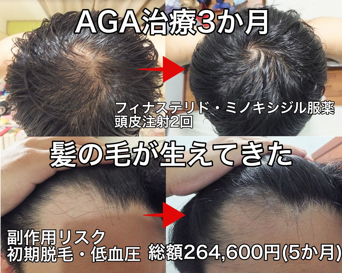 AGA治療開始前と3ヵ月後比較　てっぺんハゲ＆M字ハゲ