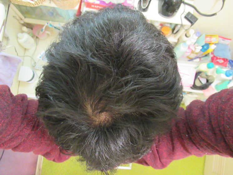 AGA治療開始2年3ヶ月のてっぺんハゲ・髪の毛がパサつく