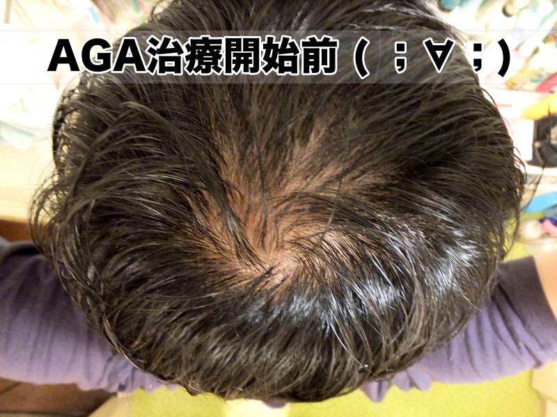 0ヶ月：AGA治療開始前・頭頂部てっぺんハゲの様子
