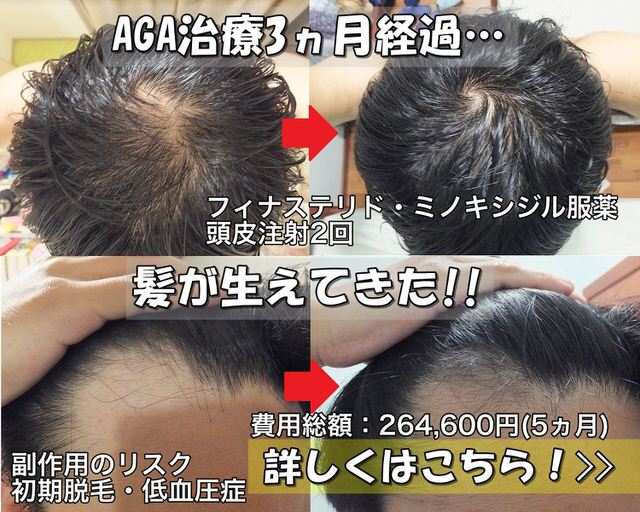 AGA治療開始前と3ヵ月後比較写真